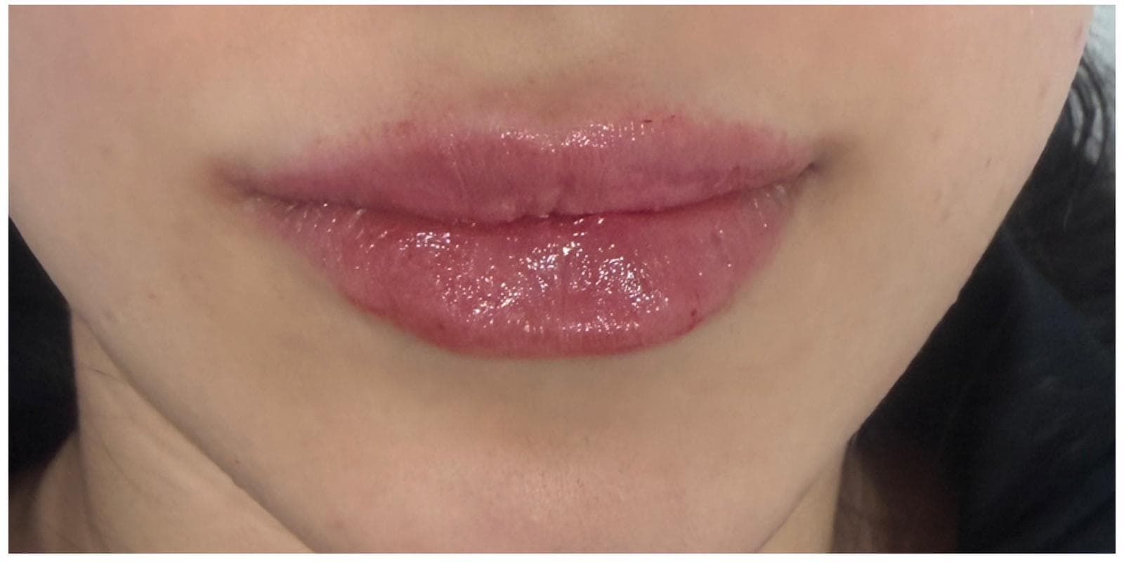 Lip Fillers after